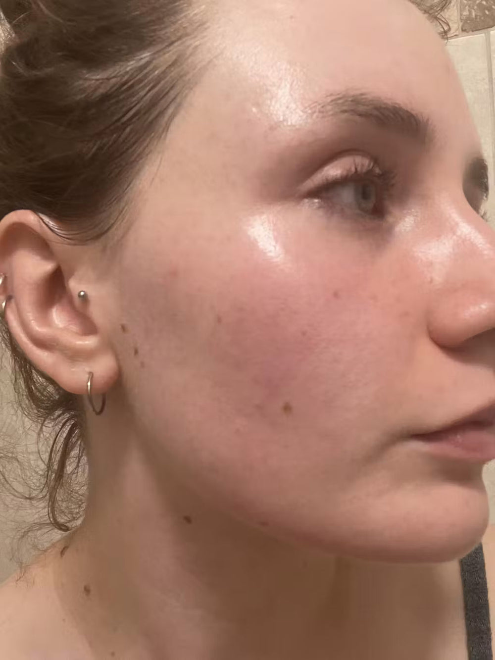 acne PL keep