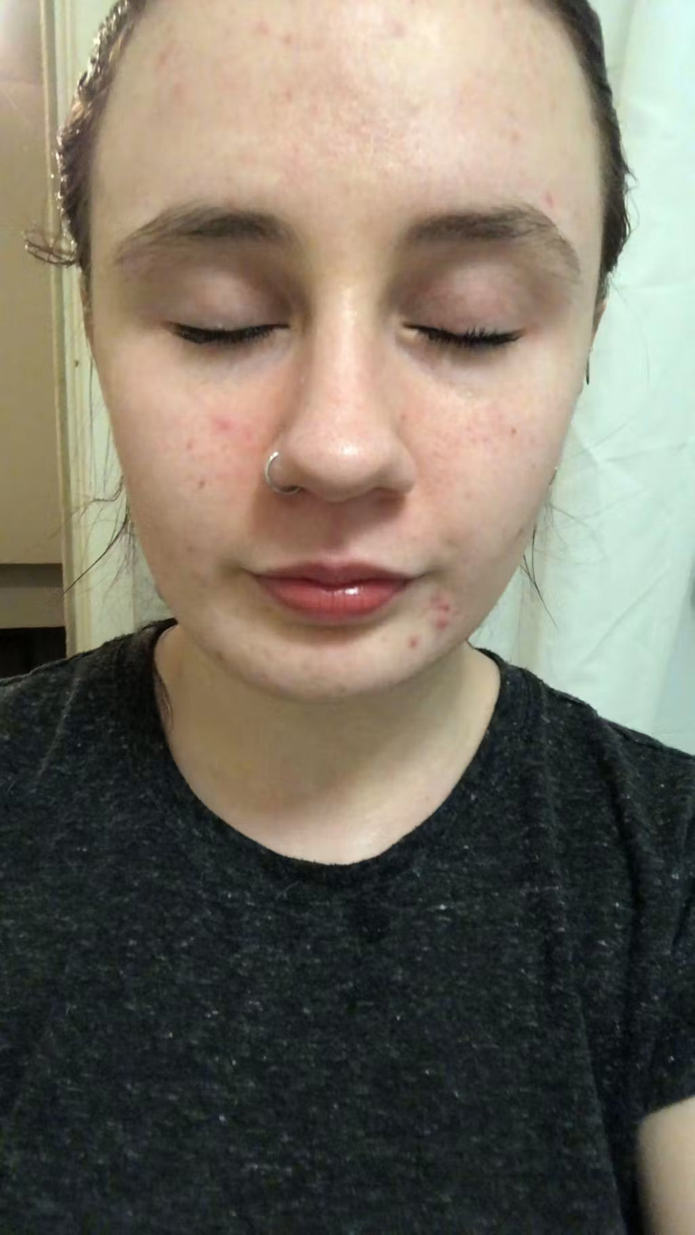 acne PL keep