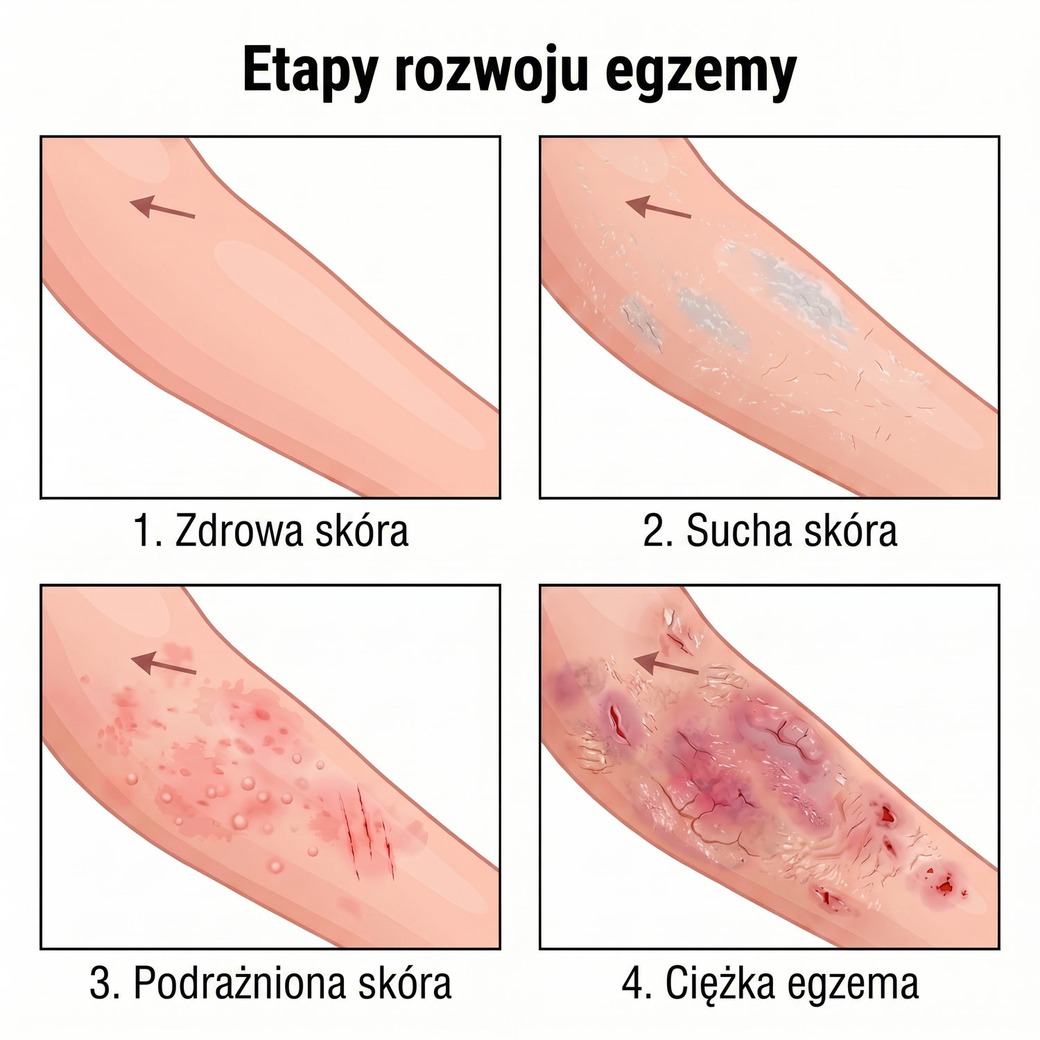 eczema_PL_eczema_4stages_v2.png
