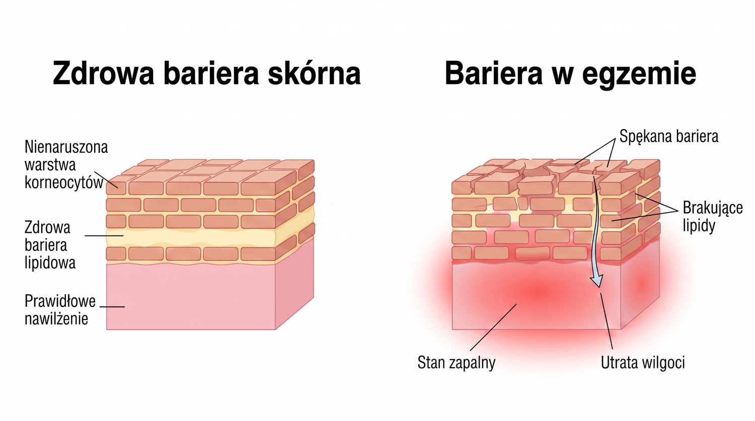 eczema_PL_skin_barrier_v2.png