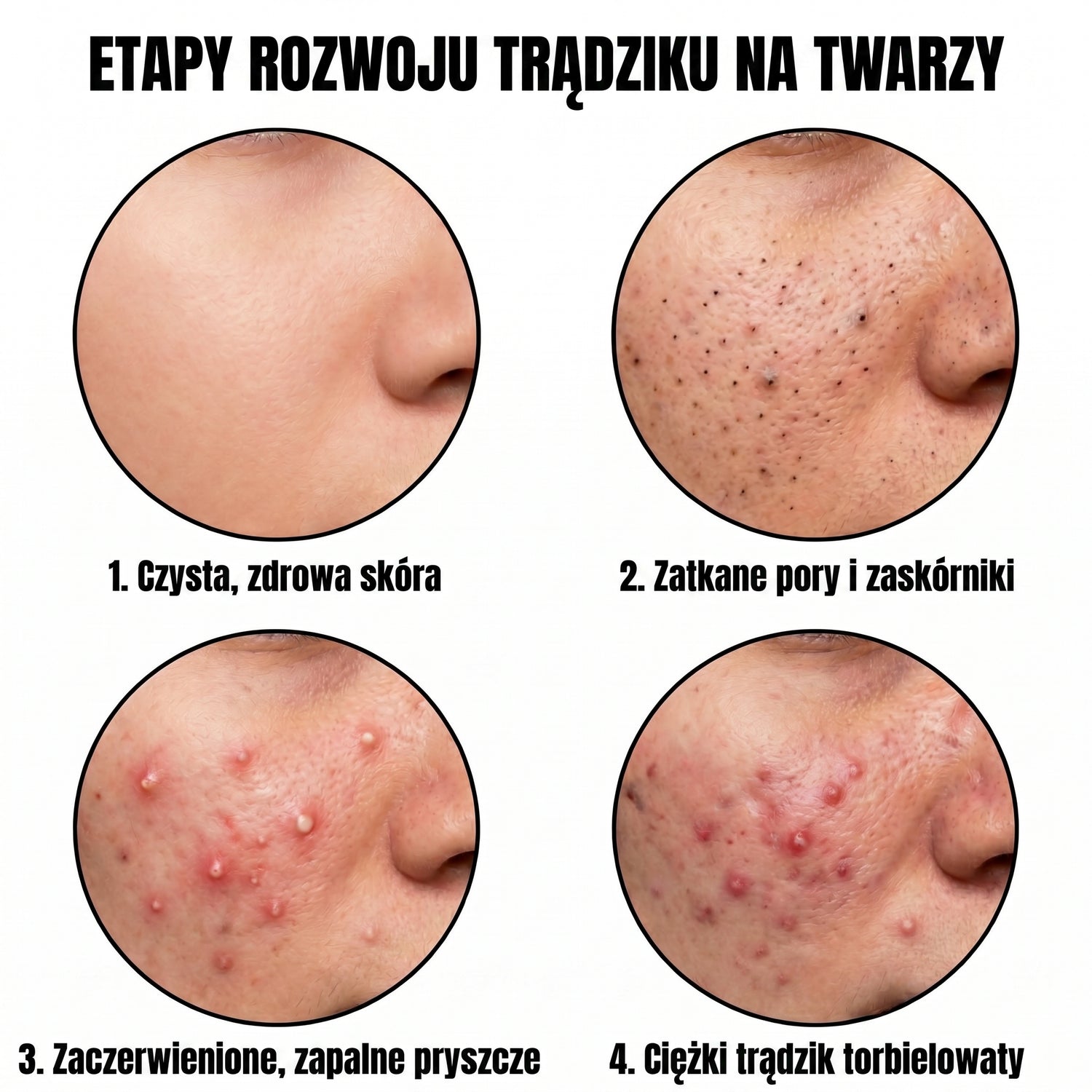 acne PL translated